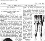 Kwashiorkor: Cicely Williams uses the name for the first time in 1935